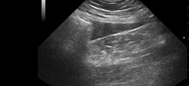 Ultrasound abdomen